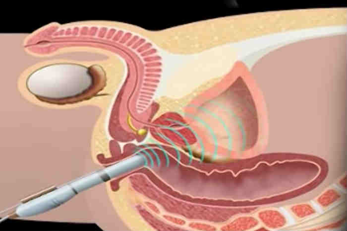 biopsia prostata fusion