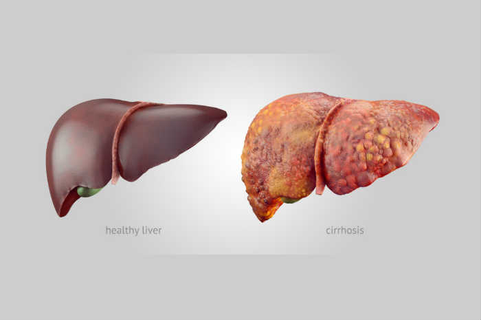 Fegato sano e fegato cirrotico