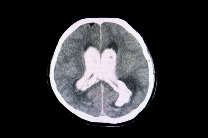 ematoma intracranico