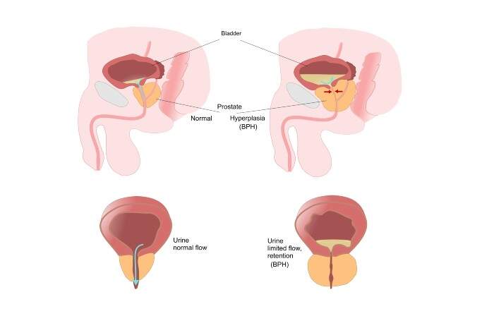 Video de biopsia de próstata youtube. Cadena de montaje cxd00093 youtube movie