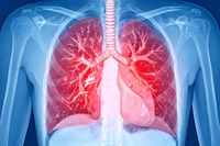 Embolia polmonare acuta: cosa cambia con le nuove Linee Guida AHA/ACC 2026 