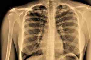 Enfisema polmonare