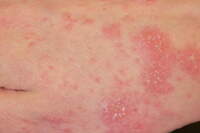 Bari, sospetta scabbia al Policlinico: 22 sanitari al Pronto soccorso