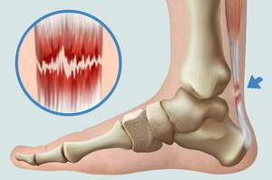 Tendinosi achillea, lesione del tendine di Achille