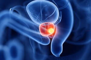 Tumore della prostata