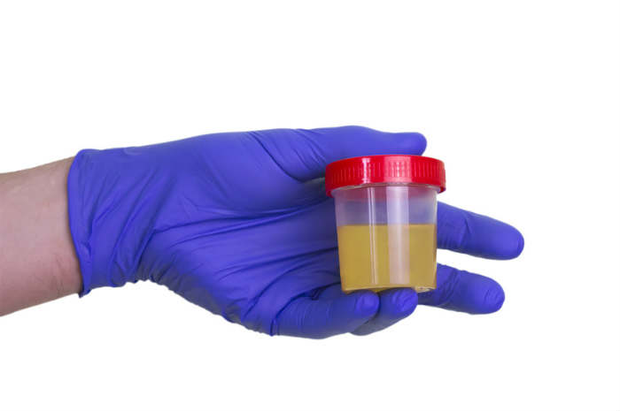 Culoarea urinei îți poate indica dacă ai o infecție urinară sau cancer
