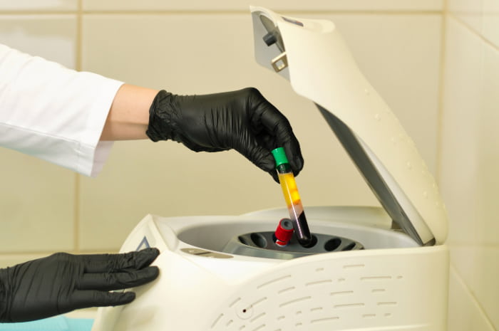 Plasma ricco di piastrine (PRP) nei siti donatori di innesto cutaneo