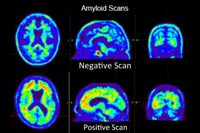 Nuove frontiere terapeutiche per l'Alzheimer: i farmaci anti-amiloide