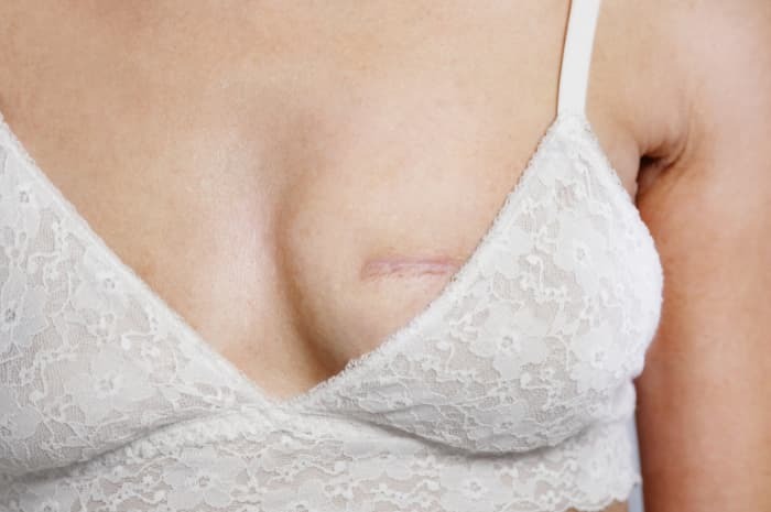 Ricostruzione mammaria: tecniche, criteri clinici e implicazioni assistenziali