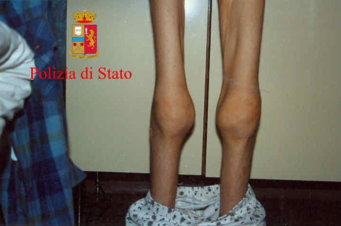 gambe di una persona anoressica
