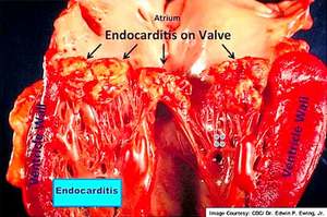 Endocardite batterica