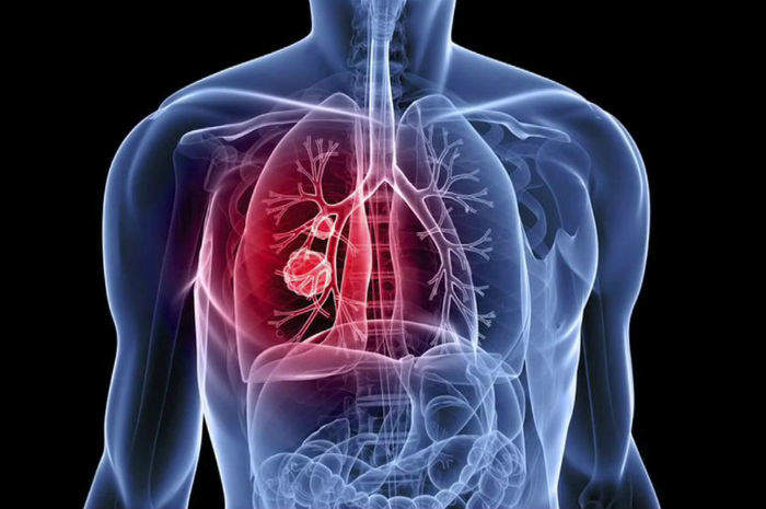 Update sul cancro polmonare, corso Ecm a Fano