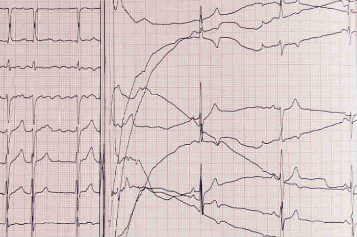 Cardioversione Elettrica e assistenza infermieristica