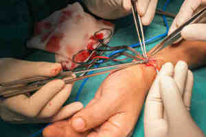 Fistola artero-venosa, gestione infermieristica in emodialisi