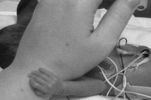 Neonata prematura abbraccia l'infermiera, la foto è virale