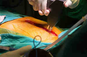 Apertura chirurgica dello sterno, la sternotomia