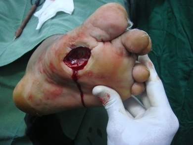 Ulcere del piede diabetico, un convegno scientifico a Cotignola con corso ECM