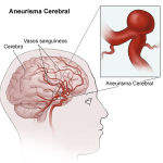 aneurisma_cerebral