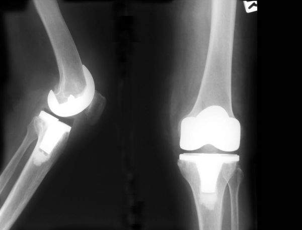 SIOT: artrosi del ginocchio e interventi salva-arto