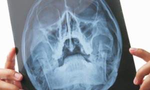 Tumore al cervello: le nuove cure del Galliera di Genova