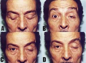 Come assistere il paziente con Miastenia Gravis?